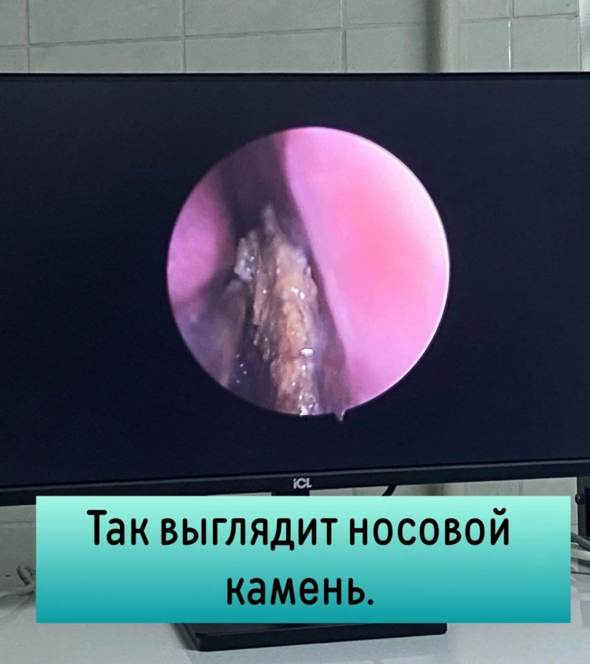 Огромный камень вырос в носу россиянки Огромный камень вырос в носу россиянки