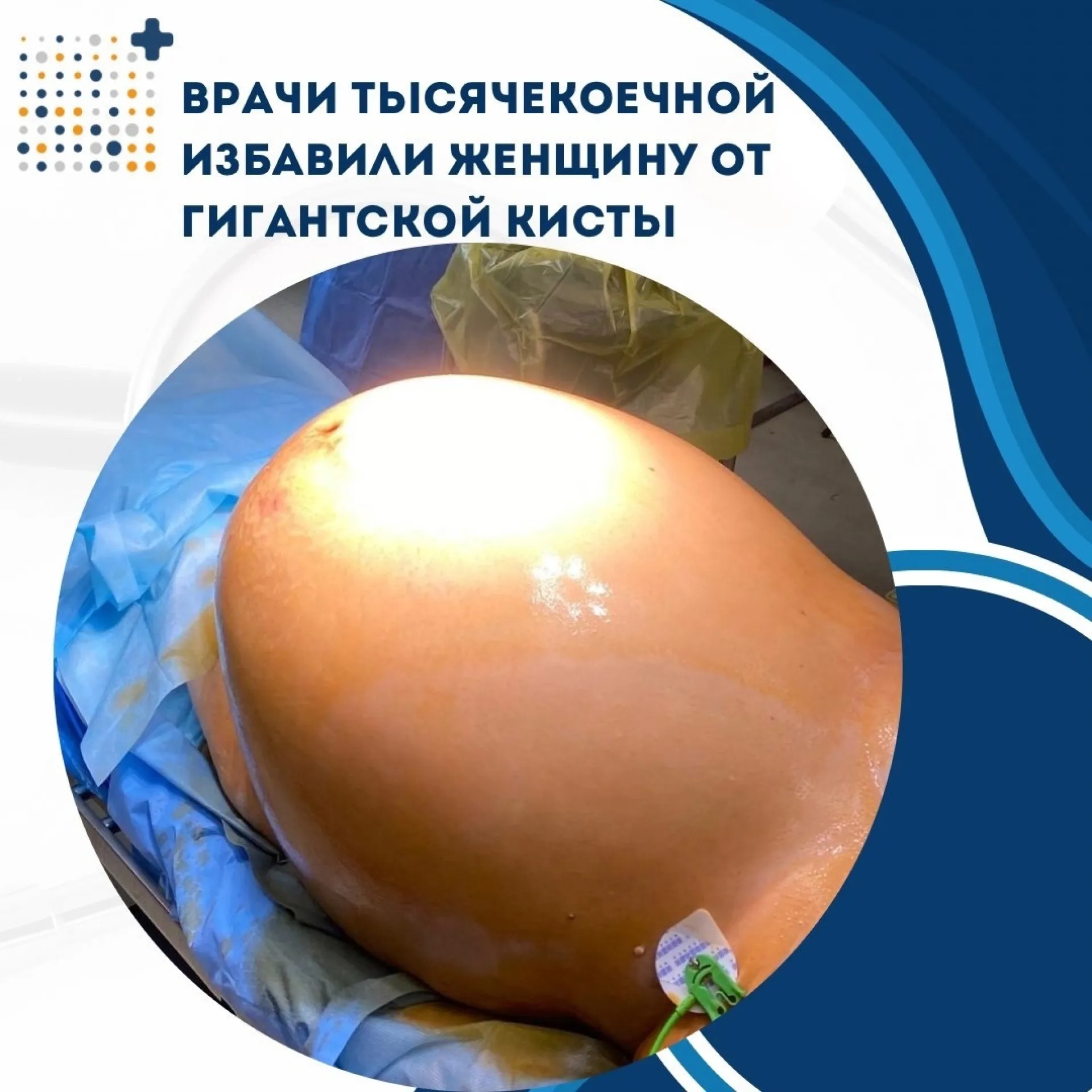 39-килограммовую опухоль яичника удалили у пациентки во Владивостоке
