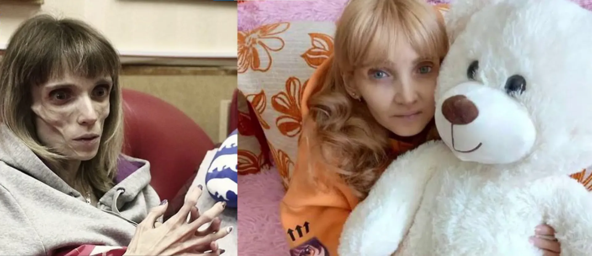 Жительница Барнаула, весившая в 23 года 17 килограмм, возвращается к обычной жизни