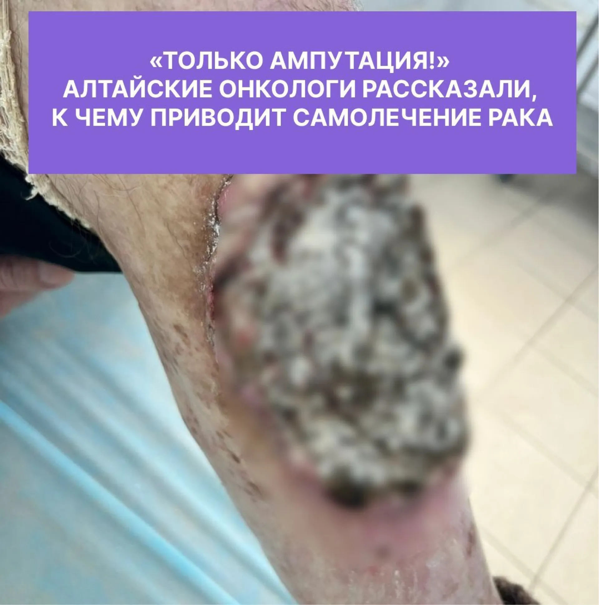 Барнаульские врачи спасли мужчину с онкологией, лечившего рак в домашних условиях Барнаульские врачи спасли мужчину с онкологией, лечившего рак в домашних условиях