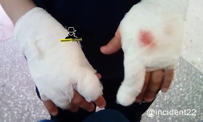 Соцсети: собака серьёзно травмировала руки мальчика в Барнауле