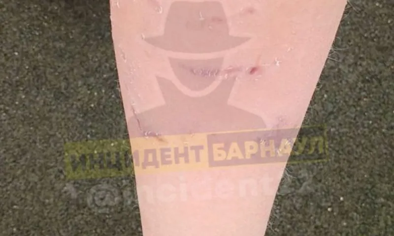 Уголовное дело после нападения собак на ребенка в Алтайском крае поручил возбудить председатель СК РФ