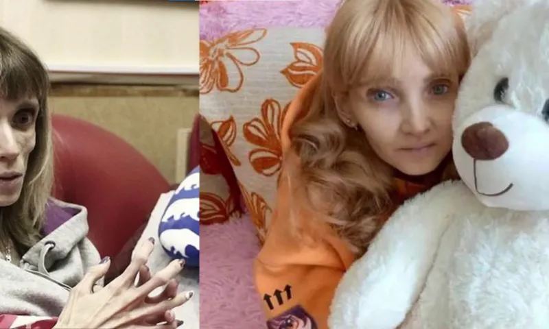Жительница Барнаула, весившая в 23 года 17 килограмм, возвращается к обычной жизни